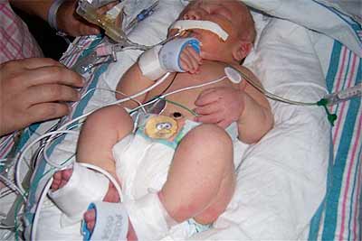 Patau Syndrome Patau (2).jpg